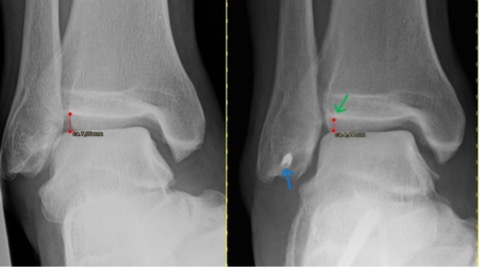 Links vor der Operation mit Fehlstellung, rechts postoperativ. Pfeil blau: Titananker im Außenknöchel; Pfeil grün: durch Bandstraffung und Achskorrektur erreichte physiologische Gelenkstellung