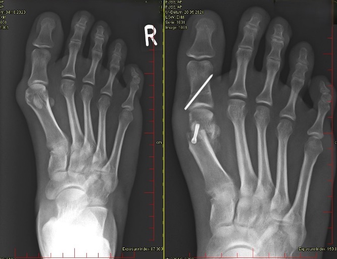 Kombinierte Chevron und Akin Osteotomie