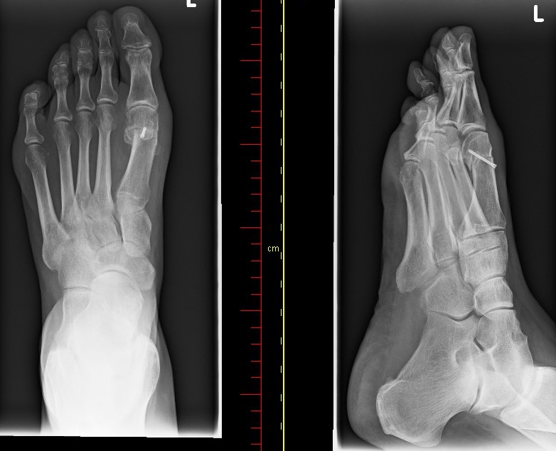 Hallux rigidus – Die Osteotomie