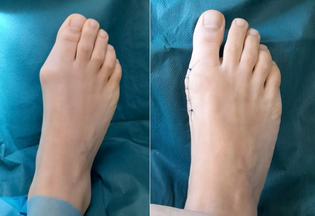 Hallux valgus: Vergleich prä- und postoperativ