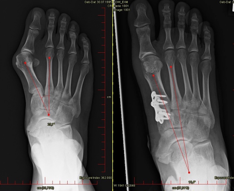 Lapidus Arthrodese