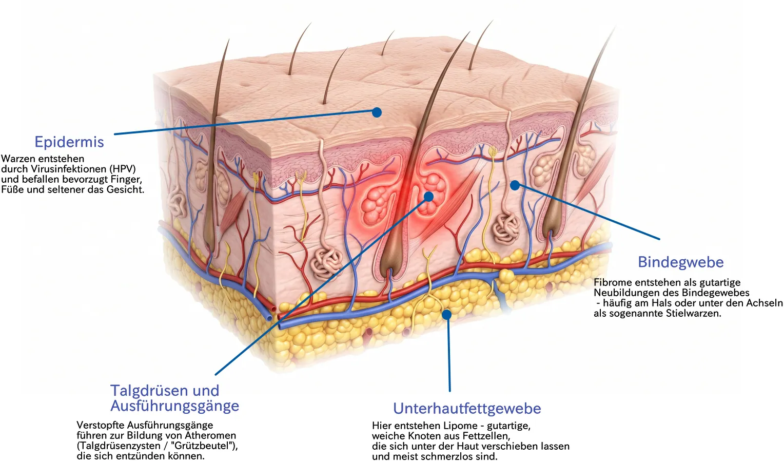 Anatomie der Haut – Epidermis, Bindegewebe, Talgdrüsen und Unterhautfettgewebe mit typischen Tumorlokalisationen